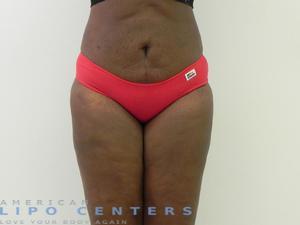 americanlipocenters_42.jpg